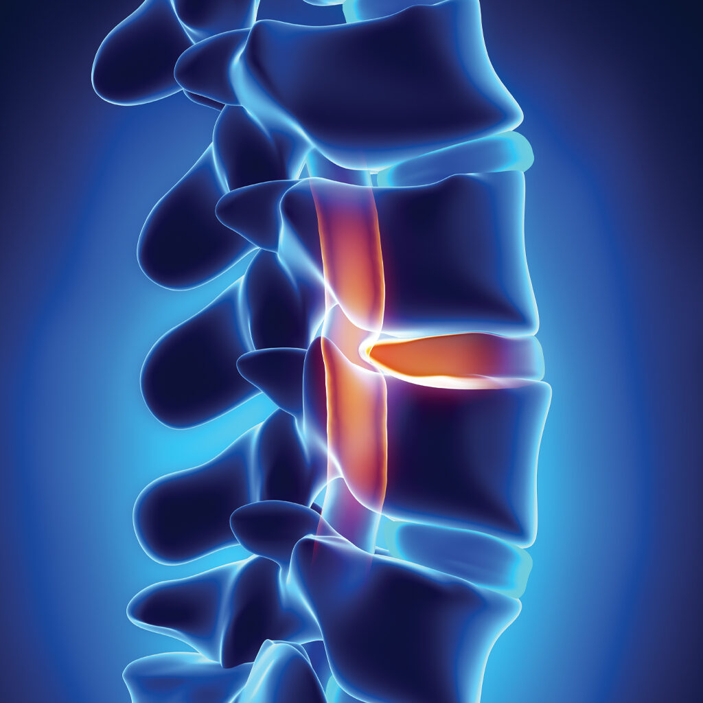 Herniated disc treatment in Denver, CO at Allpria Healthcare