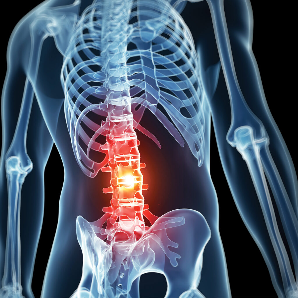 Treat Degenerative Disc Disease - Denver pain specialists - Allpria Healthcare